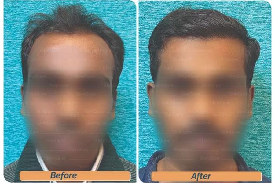 Hair transplant before and after in Delhi – 27-year-old male, Norwood III, 2,800 grafts with EnRiched-FUE, result at 8 months (photo 3)