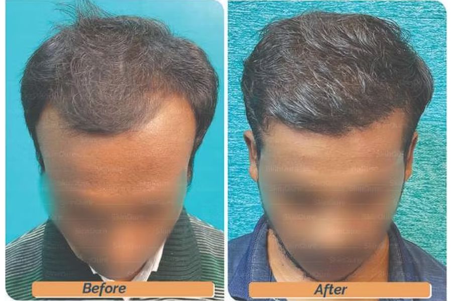 Hair transplant before and after in Delhi – 27-year-old male, Norwood III, 2,800 grafts with EnRiched-FUE, result at 8 months (photo 4)