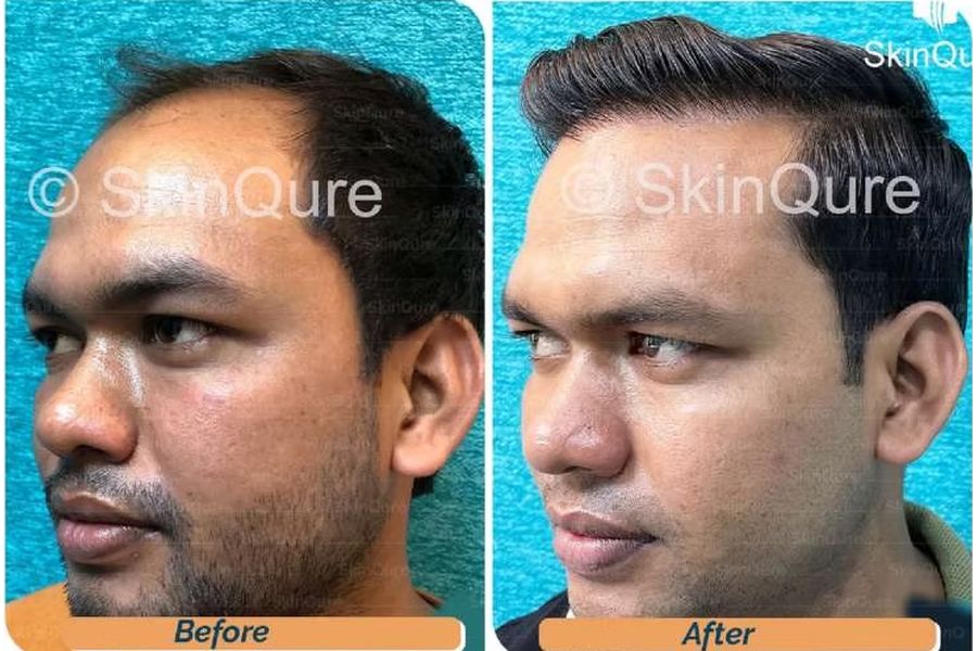 Hair transplant before and after in Delhi – 27-year-old male, Norwood IV, 3,160 grafts with EnRiched-FUE, result at 8 months (photo 1)