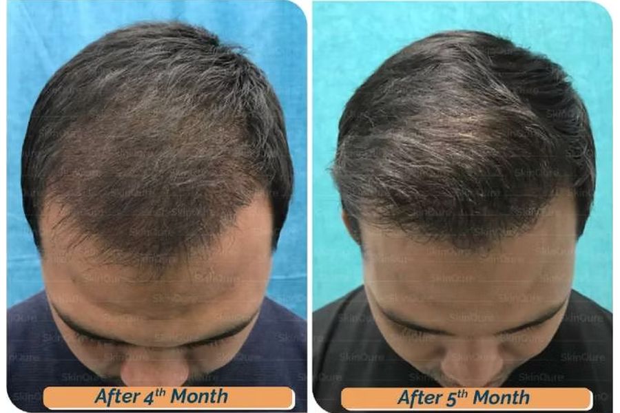 Hair transplant before and after in Delhi – 27-year-old male, Norwood IV, 3,160 grafts with EnRiched-FUE, result at 8 months (photo 2)