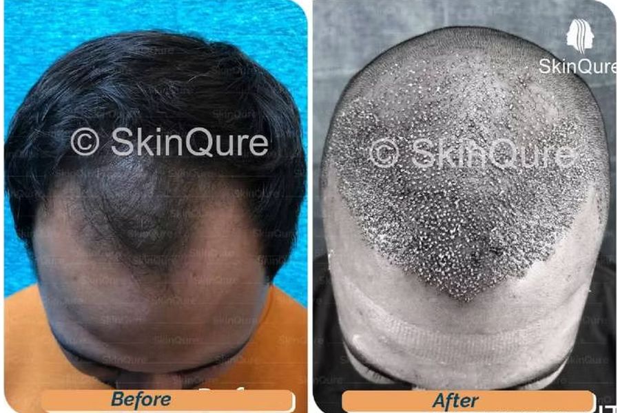 Hair transplant before and after in Delhi – 27-year-old male, Norwood IV, 3,160 grafts with EnRiched-FUE, result at 8 months (photo 3)