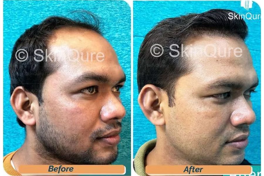 Hair transplant before and after in Delhi – 27-year-old male, Norwood IV, 3,160 grafts with EnRiched-FUE, result at 8 months (photo 4)