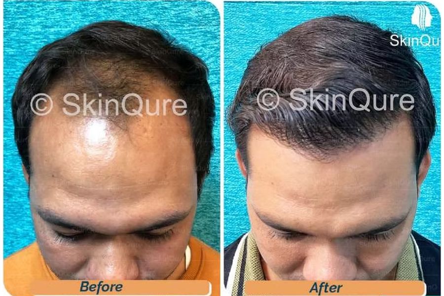 Hair transplant before and after in Delhi – 27-year-old male, Norwood IV, 3,160 grafts with EnRiched-FUE, result at 8 months (photo 5)