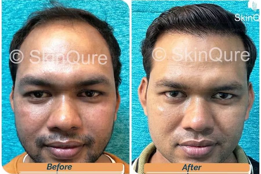 Hair transplant before and after in Delhi – 27-year-old male, Norwood IV, 3,160 grafts with EnRiched-FUE, result at 8 months (photo 6)