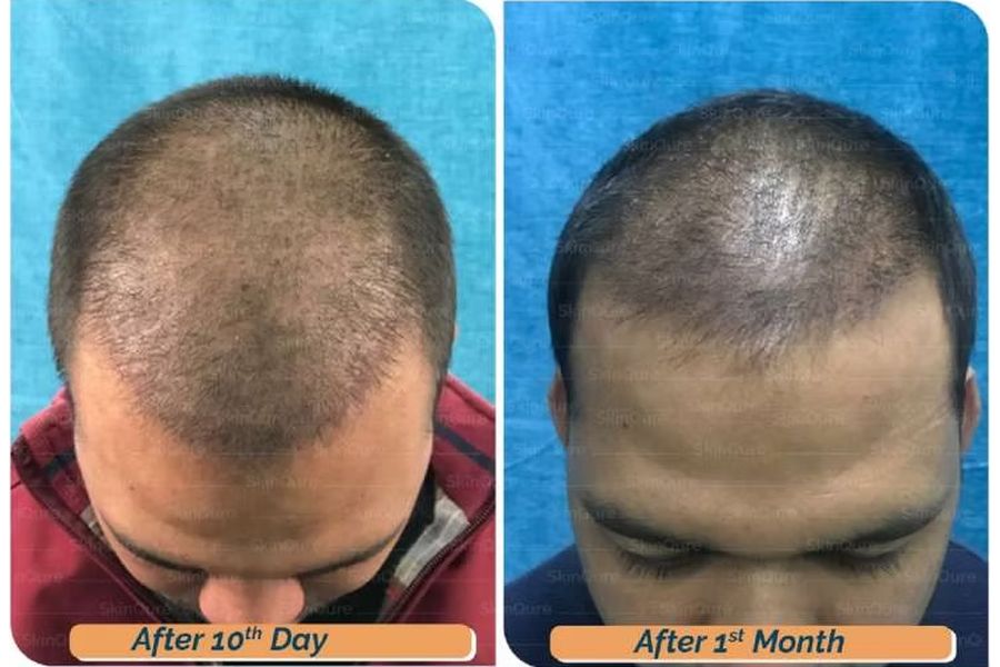 Hair transplant before and after in Delhi – 27-year-old male, Norwood IV, 3,160 grafts with EnRiched-FUE, result at 8 months (photo 7)