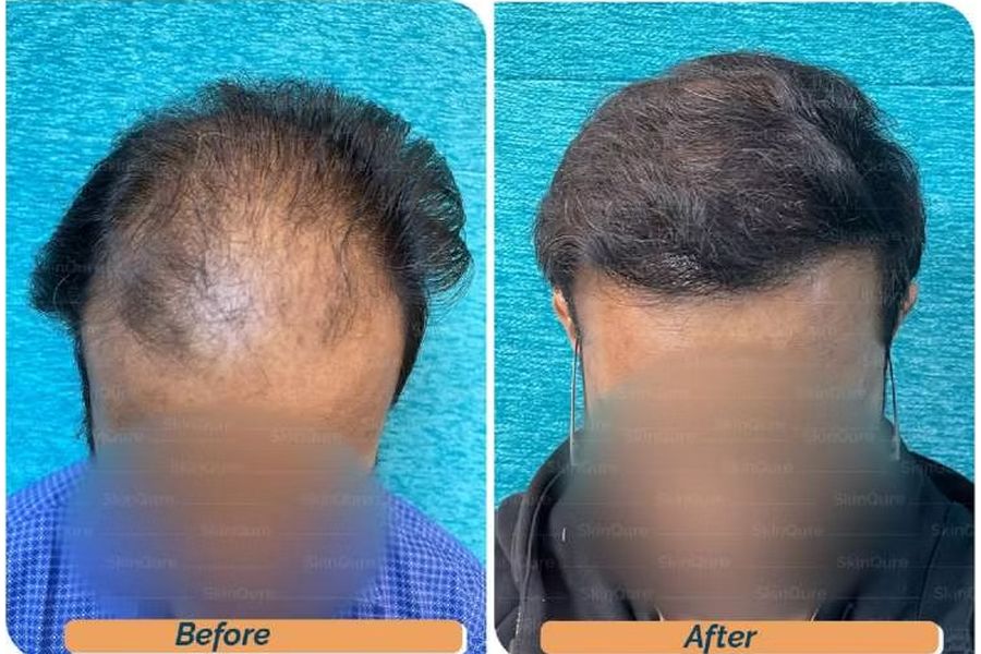Hair transplant before and after in Delhi – 27-year-old male, Norwood V, 3,310 grafts with Bio-FUE, result at 7 months (photo 1)