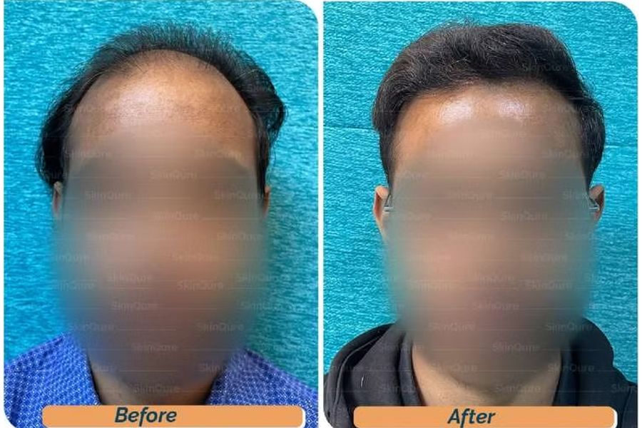 Hair transplant before and after in Delhi – 27-year-old male, Norwood V, 3,310 grafts with Bio-FUE, result at 7 months (photo 2)