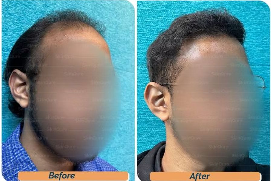 Hair transplant before and after in Delhi – 27-year-old male, Norwood V, 3,310 grafts with Bio-FUE, result at 7 months (photo 3)