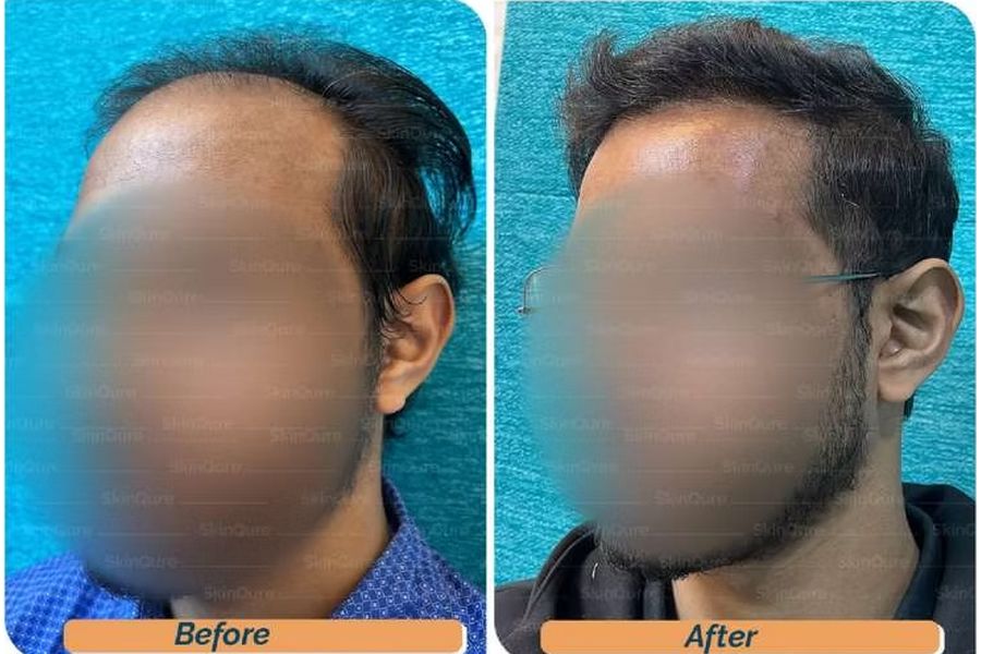 Hair transplant before and after in Delhi – 27-year-old male, Norwood V, 3,310 grafts with Bio-FUE, result at 7 months (photo 4)