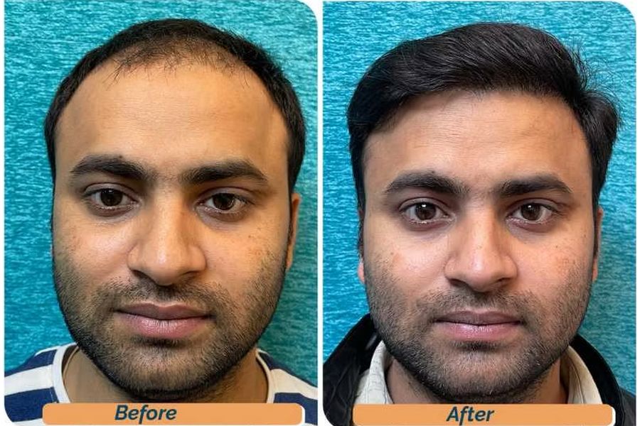 Hair transplant before and after in Delhi – 28-year-old male, Norwood IV, 3,010 grafts with EnRiched-FUE, result at 8 months (photo 1)