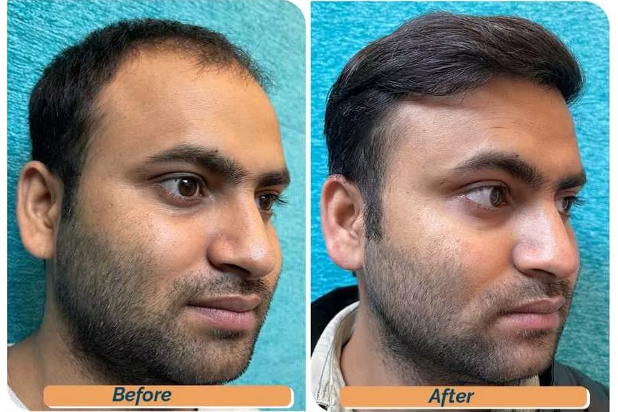 Hair transplant before and after in Delhi – 28-year-old male, Norwood IV, 3,010 grafts with EnRiched-FUE, result at 8 months (photo 2)