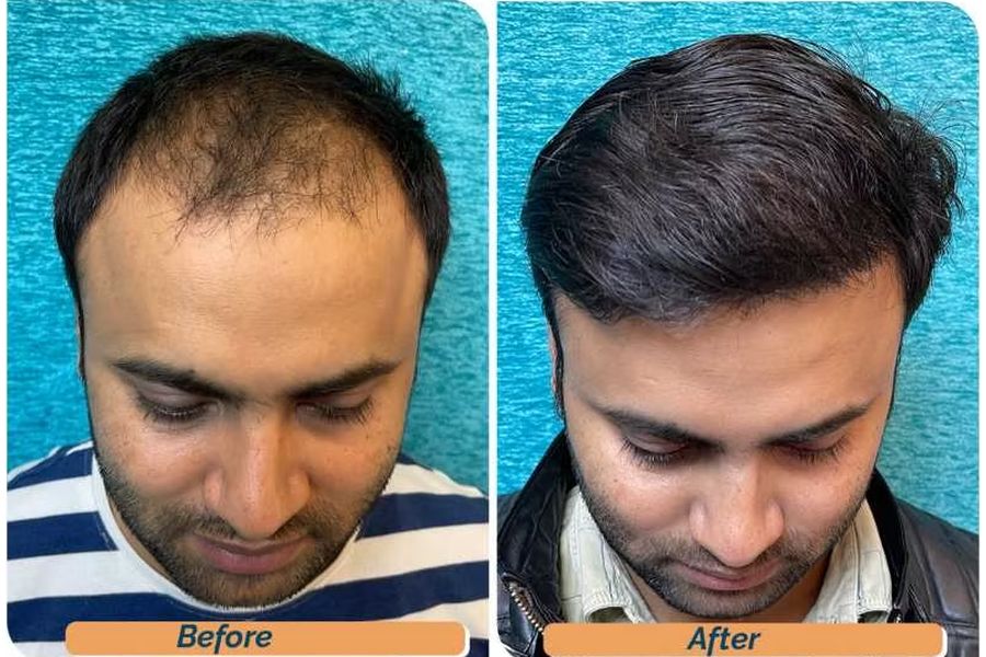 Hair transplant before and after in Delhi – 28-year-old male, Norwood IV, 3,010 grafts with EnRiched-FUE, result at 8 months (photo 3)