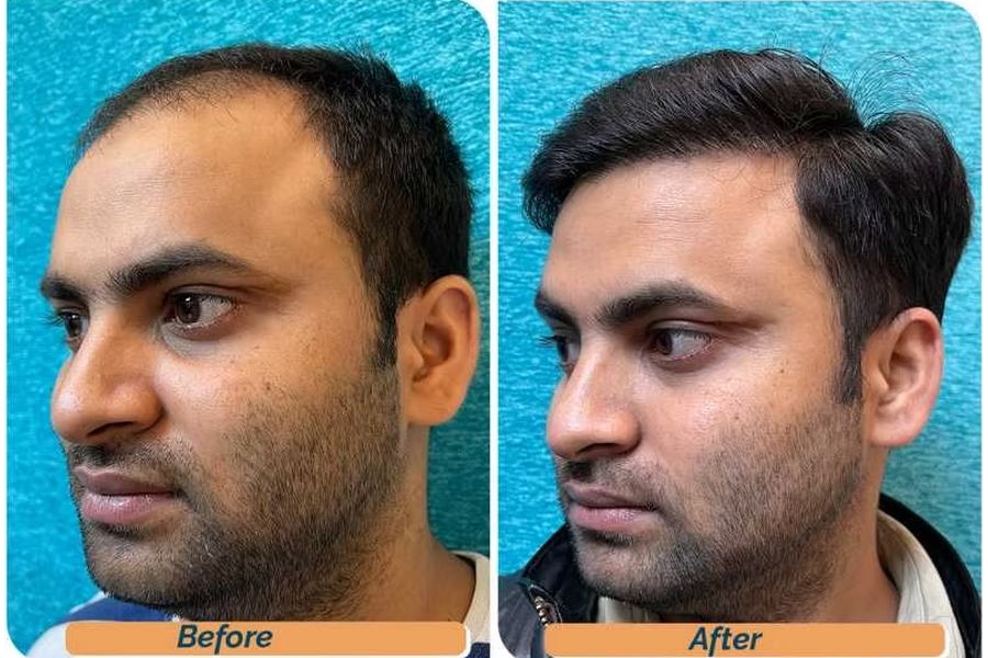 Hair transplant before and after in Delhi – 28-year-old male, Norwood IV, 3,010 grafts with EnRiched-FUE, result at 8 months (photo 4)
