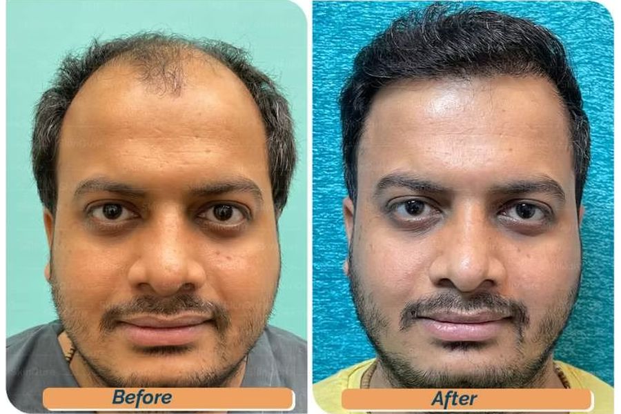 Hair transplant before and after in Delhi – 28-year-old male, Norwood IV, 3,870 grafts with EnRiched-FUE, result at 9 months (photo 1)