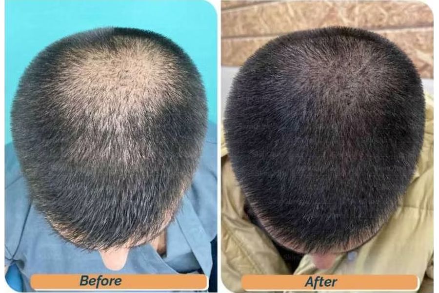 Hair transplant before and after in Delhi – 29-year-old male, Crown Hair Transplant, 1,600 grafts with EnRiched-FUE, result at 11 months (photo 1)