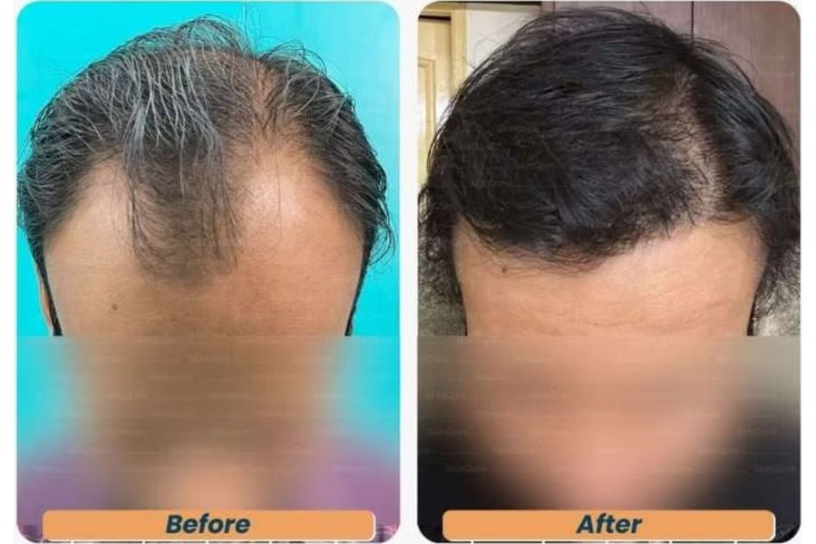 Hair transplant before and after in Delhi – 29-year-old male, Norwood IV, 2,642 grafts with EnRiched-FUE, result at 6 months (photo 1)