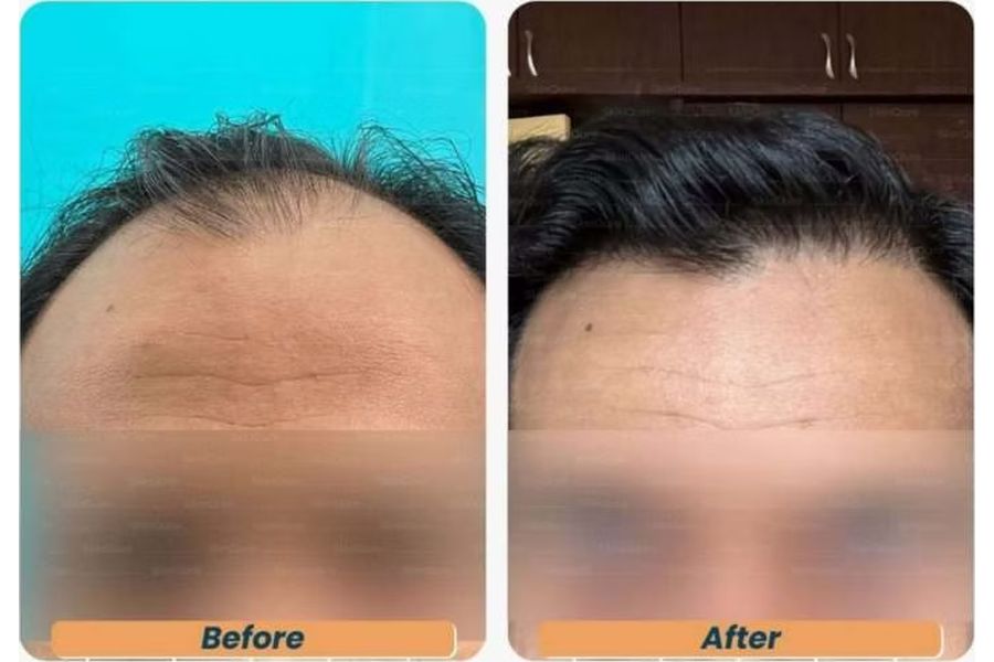 Hair transplant before and after in Delhi – 29-year-old male, Norwood IV, 2,642 grafts with EnRiched-FUE, result at 6 months (photo 2)