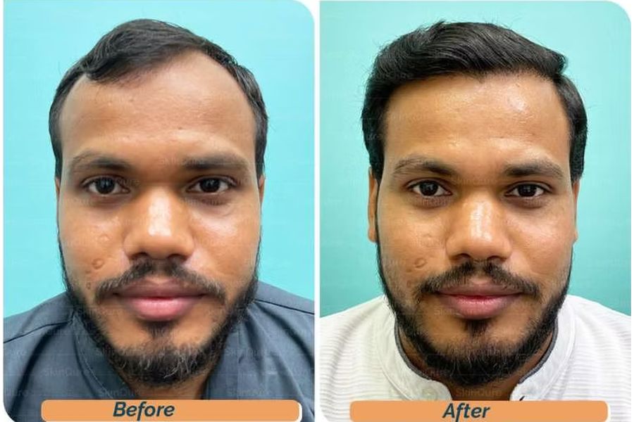 Hair transplant before and after in Delhi – 29-year-old male, Norwood III, 3,300 grafts with EnRiched-FUE, result at 8 months (photo 1)