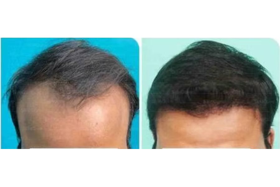 Hair transplant before and after in Delhi – 29-year-old male, Norwood III, 3,300 grafts with EnRiched-FUE, result at 11 months (photo 1)