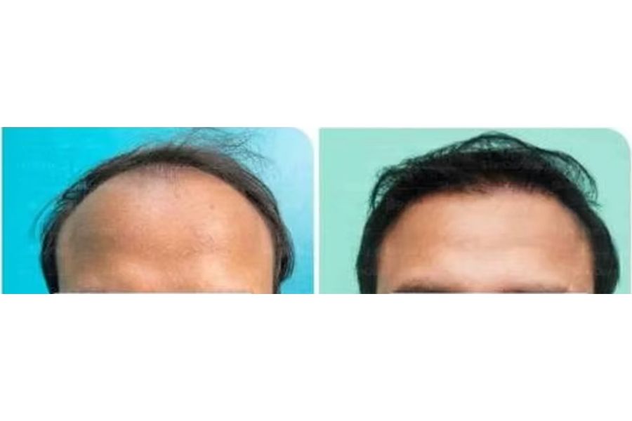 Hair transplant before and after in Delhi – 29-year-old male, Norwood III, 3,300 grafts with EnRiched-FUE, result at 11 months (photo 2)