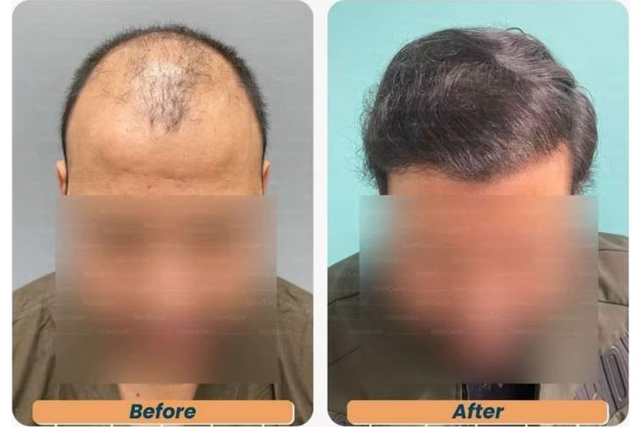 Hair transplant before and after in Delhi – 29-year-old male, Norwood V, 3,348 grafts with EnRiched-FUE, result at 6 months (photo 1)