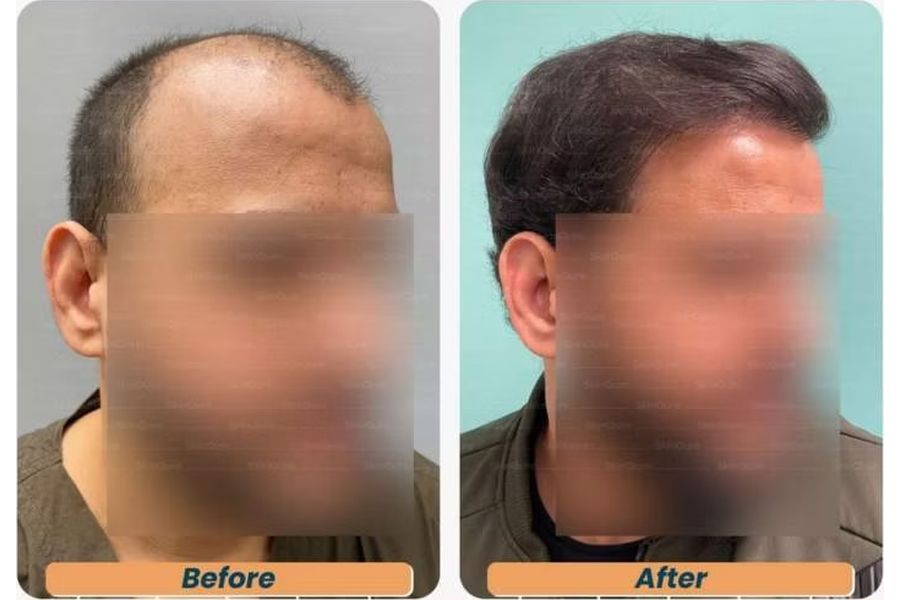 Hair transplant before and after in Delhi – 29-year-old male, Norwood V, 3,348 grafts with EnRiched-FUE, result at 6 months (photo 2)