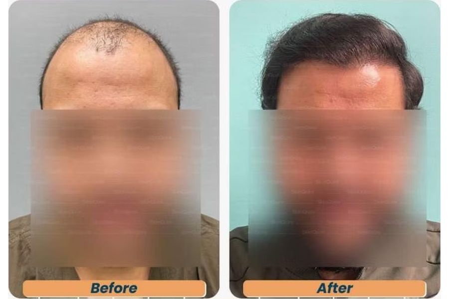Hair transplant before and after in Delhi – 29-year-old male, Norwood V, 3,348 grafts with EnRiched-FUE, result at 6 months (photo 3)