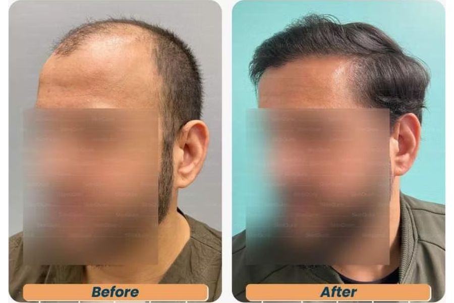 Hair transplant before and after in Delhi – 29-year-old male, Norwood V, 3,348 grafts with EnRiched-FUE, result at 6 months (photo 4)