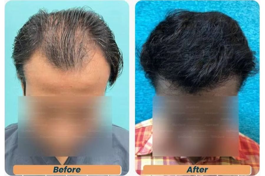 Hair transplant before and after in Delhi – 29-year-old male, Norwood V, 3,348 grafts with EnRiched-FUE, result at 6 months (photo 1)