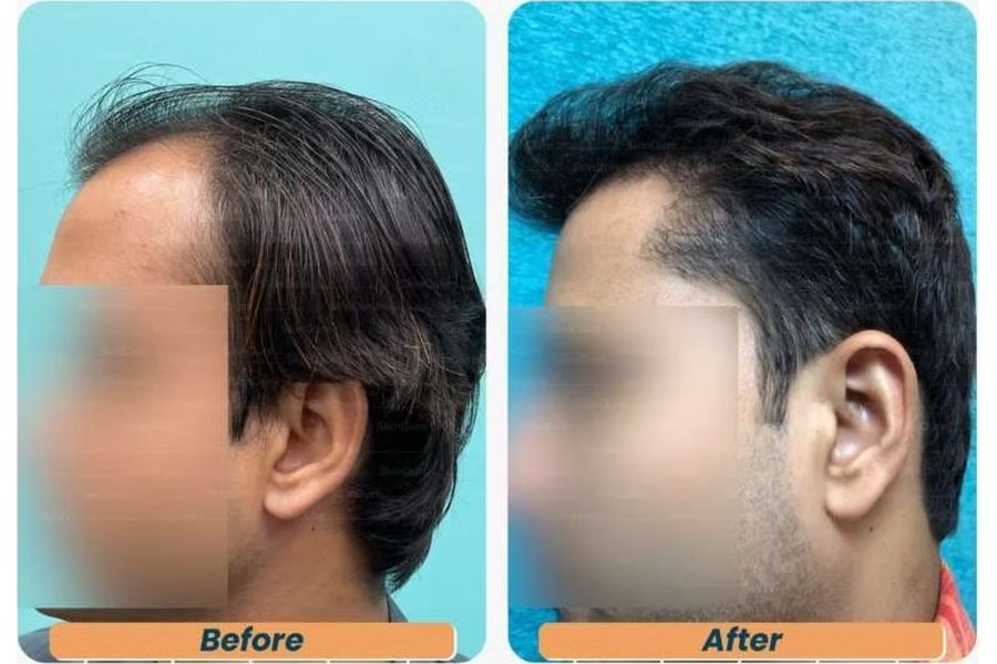 Hair transplant before and after in Delhi – 29-year-old male, Norwood V, 3,348 grafts with EnRiched-FUE, result at 6 months (photo 2)