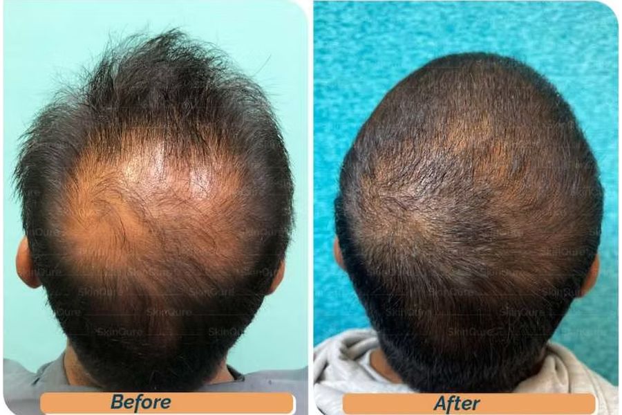 Hair transplant before and after in Delhi – 29-year-old male, Norwood IVa, 4,200 grafts with EnRiched-FUE, result at 7 months (photo 1)
