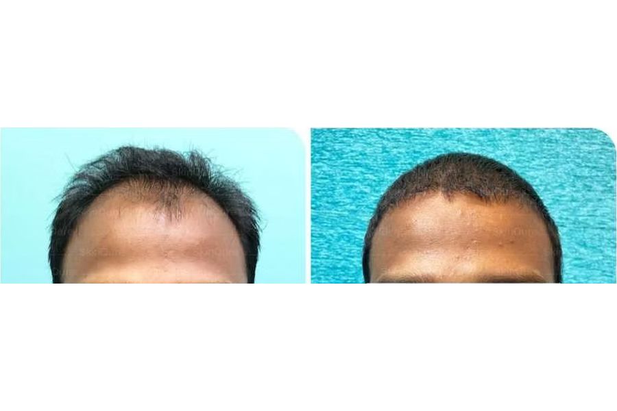Hair transplant before and after in Delhi – 29-year-old male, Norwood IVa, 4,200 grafts with EnRiched-FUE, result at 7 months (photo 2)