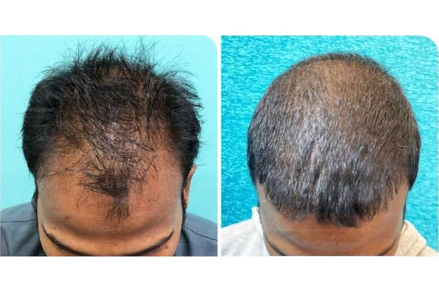 Hair transplant before and after in Delhi – 29-year-old male, Norwood IVa, 4,200 grafts with EnRiched-FUE, result at 7 months (photo 3)