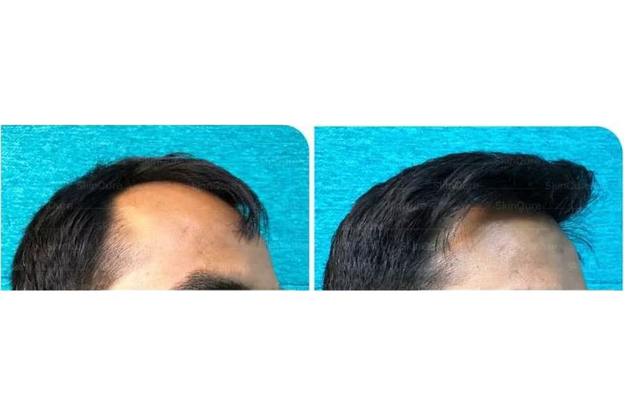 Hair transplant before and after in Delhi – 30-year-old male, Grade II, 2,300 grafts with EnRiched-FUE, result at 8 months (photo 1)