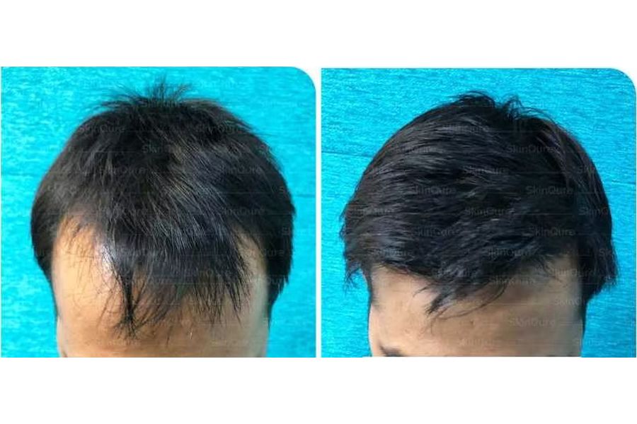 Hair transplant before and after in Delhi – 30-year-old male, Grade II, 2,300 grafts with EnRiched-FUE, result at 8 months (photo 2)