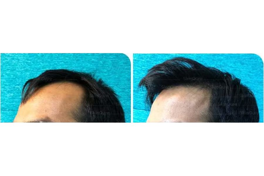 Hair transplant before and after in Delhi – 30-year-old male, Grade II, 2,300 grafts with EnRiched-FUE, result at 8 months (photo 3)