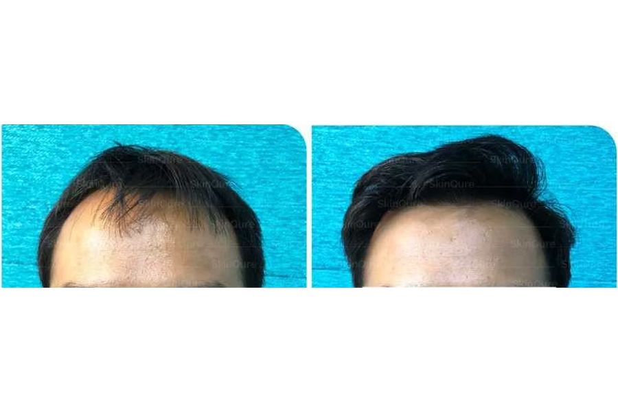 Hair transplant before and after in Delhi – 30-year-old male, Grade II, 2,300 grafts with EnRiched-FUE, result at 8 months (photo 4)
