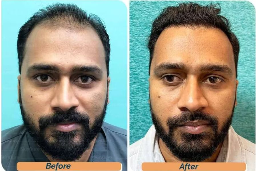 Hair transplant before and after in Delhi – 30-year-old male, Norwood IV, 3,500 grafts with EnRiched-FUE, result at 8 months (photo 1)