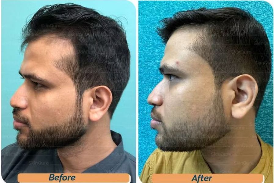 Hair transplant before and after in Delhi – 31-year-old male, Grade II, 2,200 grafts with EnRiched-FUE, result at 7 months (photo 1)