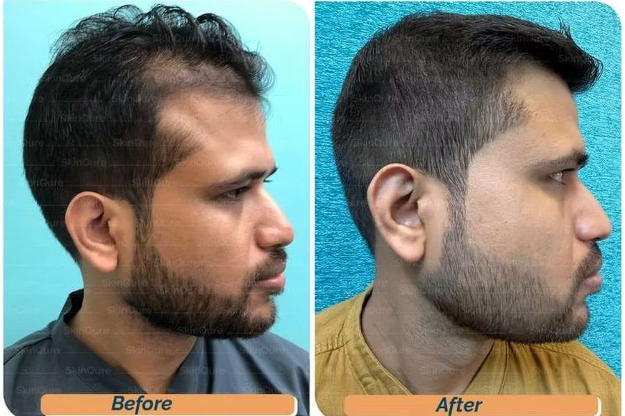 Hair transplant before and after in Delhi – 31-year-old male, Grade II, 2,200 grafts with EnRiched-FUE, result at 7 months (photo 2)