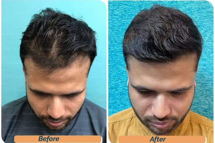 Hair transplant before and after in Delhi – 31-year-old male, Grade II, 2,200 grafts with EnRiched-FUE, result at 7 months (photo 3)