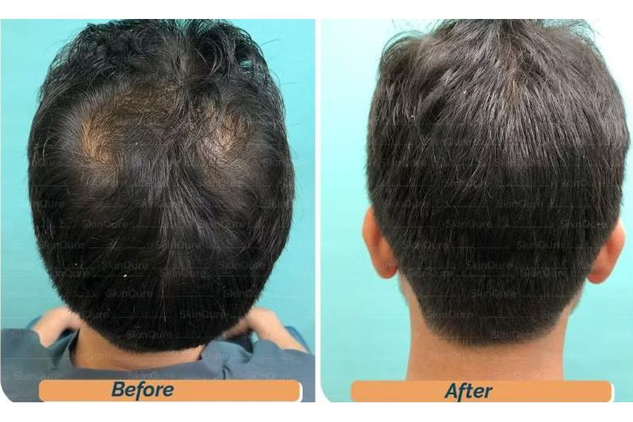 Hair transplant before and after in Delhi – 31-year-old male, Grade II, 2,200 grafts with EnRiched-FUE, result at 7 months (photo 4)