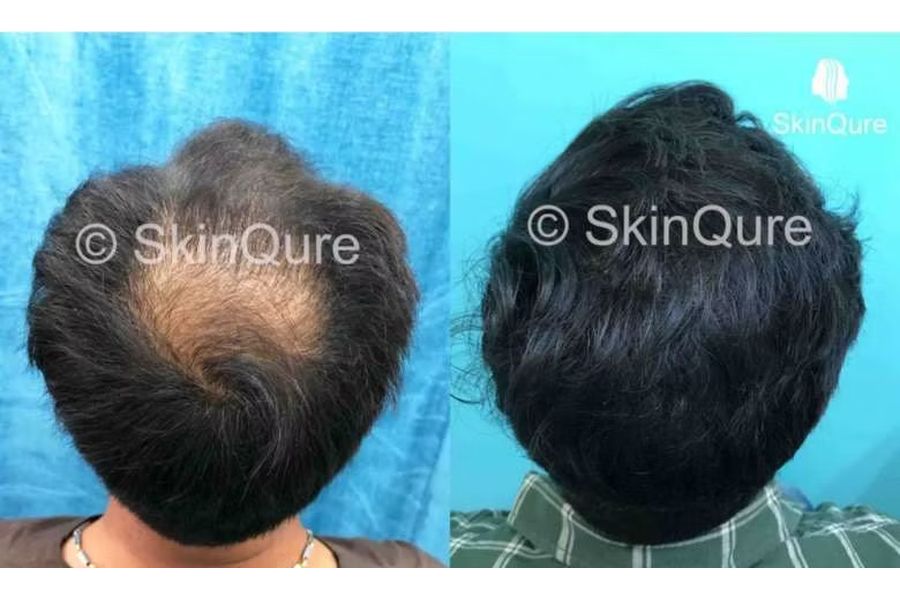 Hair transplant before and after in Delhi – 31-year-old male, Norwood IIIa, 3,000 grafts with EnRiched-FUE, result at 9 months (photo 1)
