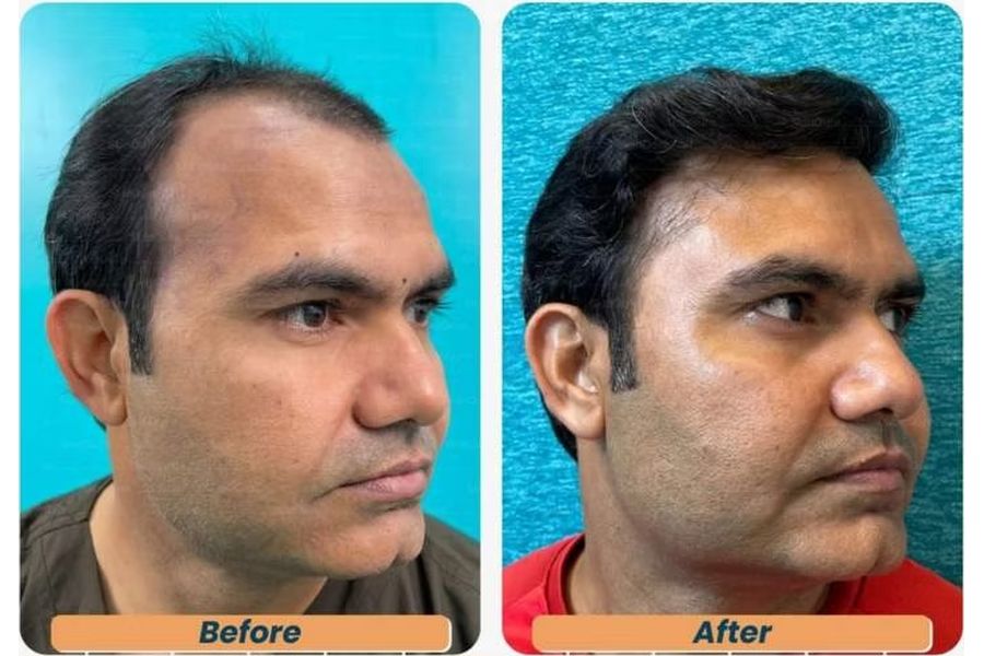 Hair transplant before and after in Delhi – 31-year-old male, Norwood IV, 3,150 grafts with EnRiched-FUE, result at 8 months (photo 1)