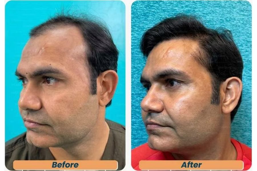 Hair transplant before and after in Delhi – 31-year-old male, Norwood IV, 3,150 grafts with EnRiched-FUE, result at 8 months (photo 2)