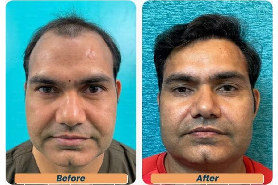 Hair transplant before and after in Delhi – 31-year-old male, Norwood IV, 3,150 grafts with EnRiched-FUE, result at 8 months (photo 3)