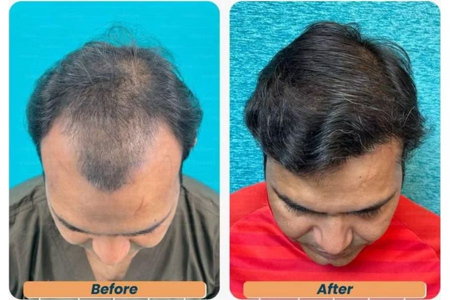 Hair transplant before and after in Delhi – 31-year-old male, Norwood IV, 3,150 grafts with EnRiched-FUE, result at 8 months (photo 4)