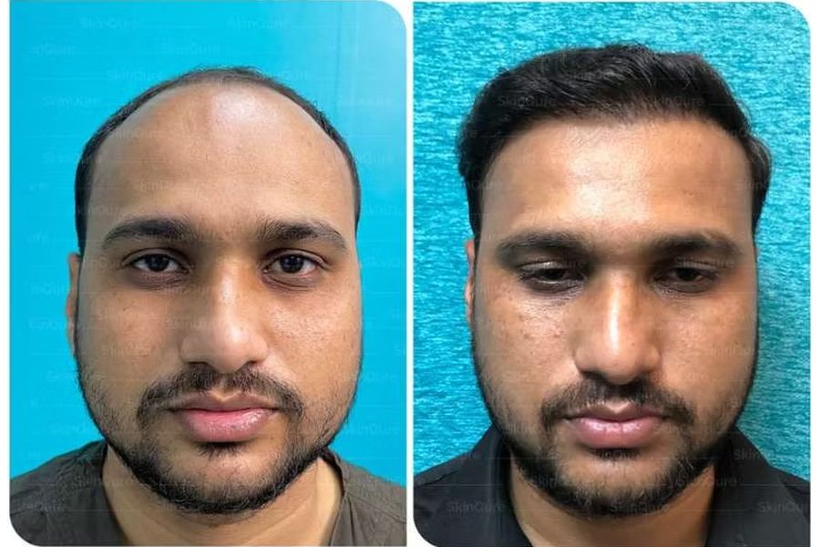 Hair transplant before and after in Delhi – 32-year-old male, Norwood IV, 3,312 grafts with EnRiched-FUE, result at 8 months (photo 1)