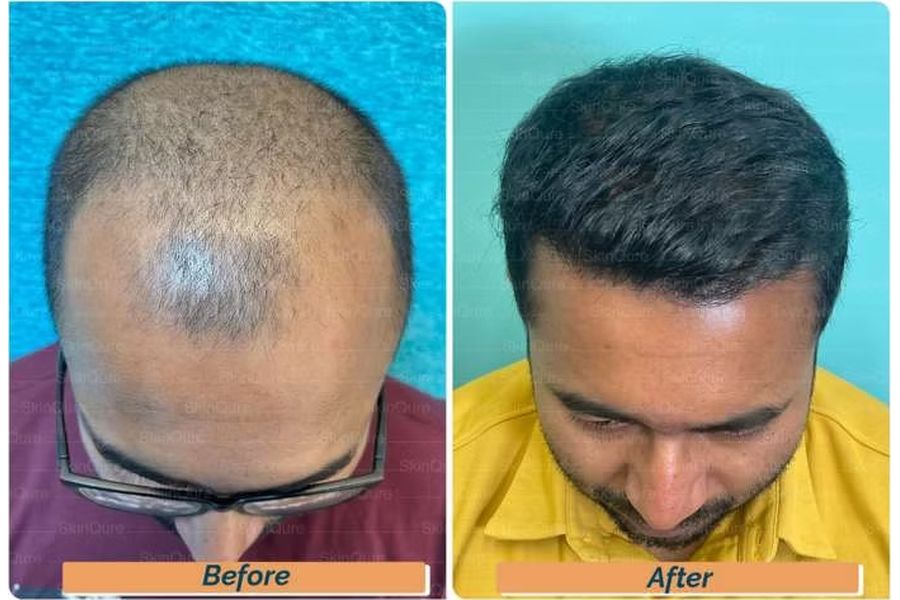 Hair transplant before and after in Delhi – 32-year-old male, Norwood IV, 3,320 grafts with Bio-FUE, result at 9 months (photo 1)