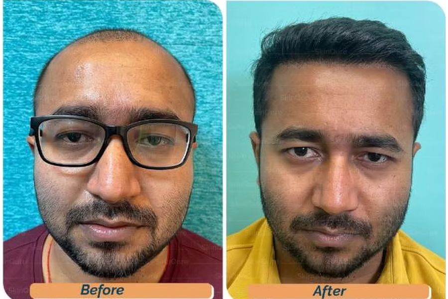 Hair transplant before and after in Delhi – 32-year-old male, Norwood IV, 3,320 grafts with Bio-FUE, result at 9 months (photo 2)